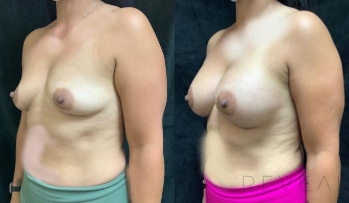 Before & After Breast Augmentation Case 405 View #5 View in San Jose, CA