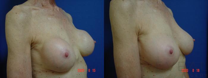 Before & After Breast Implants Case 406 View #1 View in San Jose, CA