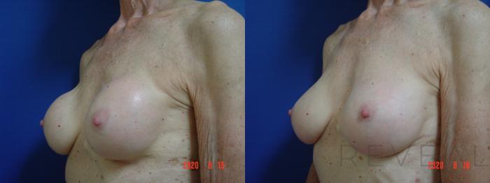 Before & After Breast Implants Case 406 View #2 View in San Jose, CA