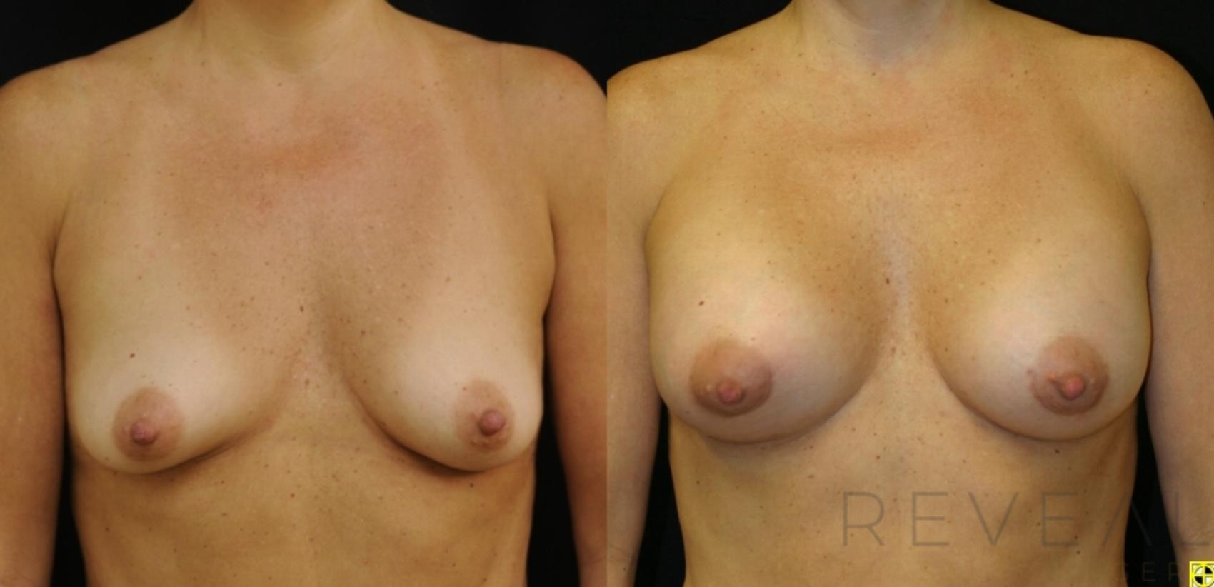 Before & After Breast Augmentation Case 418 View #1 View in San Jose, CA