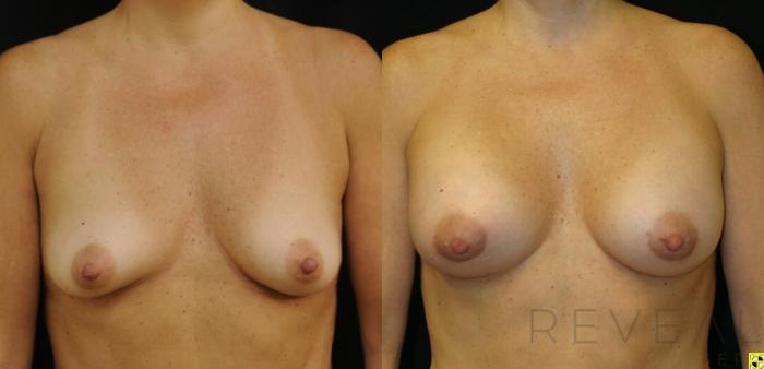 Before & After Breast Augmentation Case 418 View #1 View in San Jose, CA