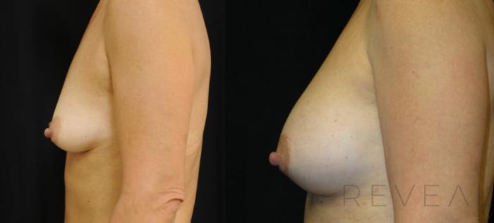 Before & After Breast Augmentation Case 418 View #2 View in San Jose, CA