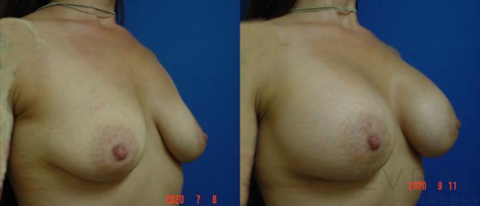 Before & After Breast Augmentation Case 422 View #3 View in San Jose, CA