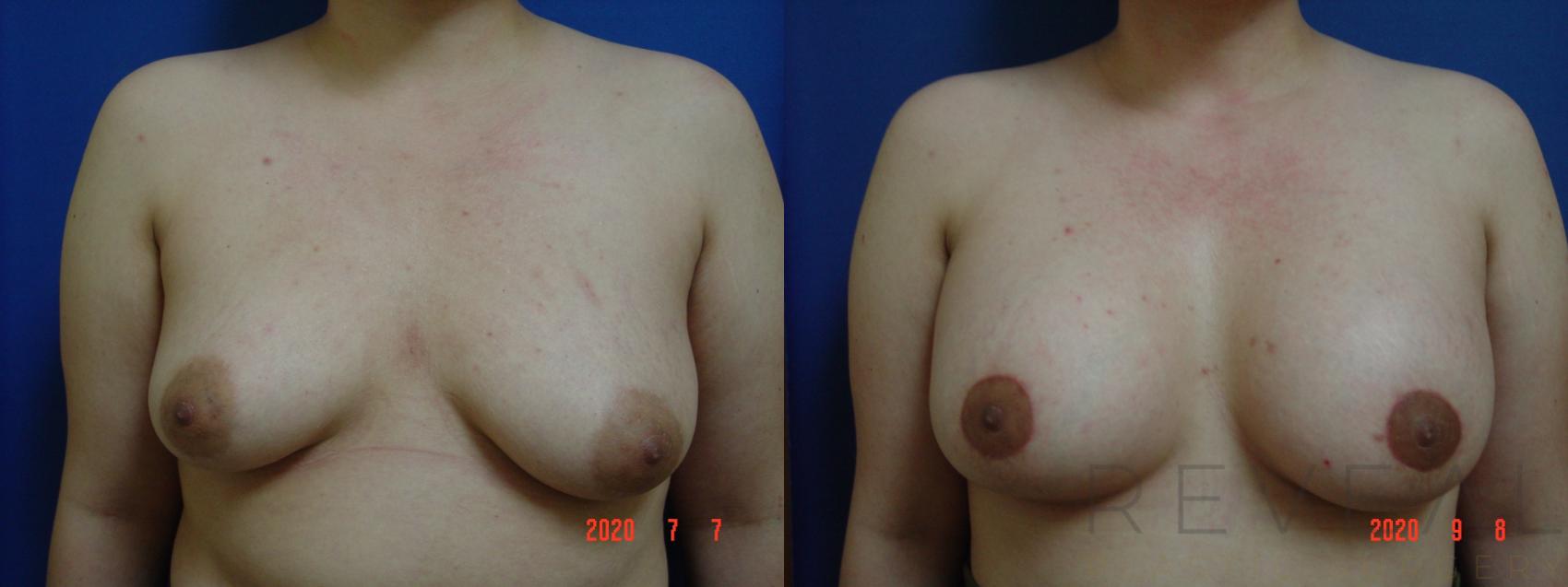 Before & After Breast Augmentation Case 423 View #1 View in San Jose, CA