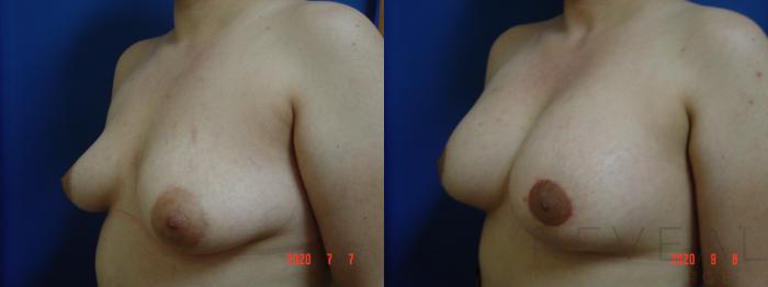 Before & After Breast Augmentation Case 423 View #2 View in San Jose, CA