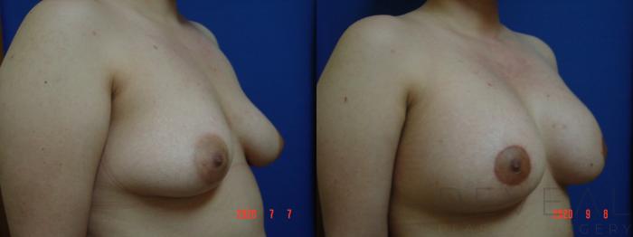 Before & After Breast Augmentation Case 423 View #3 View in San Jose, CA