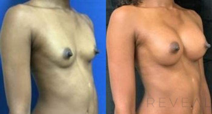 Before & After Breast Augmentation Case 425 View #1 View in San Jose, CA