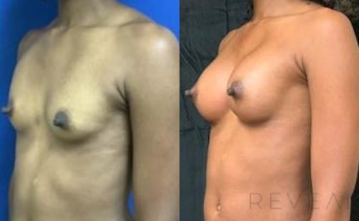 Before & After Breast Augmentation Case 425 View #2 View in San Jose, CA