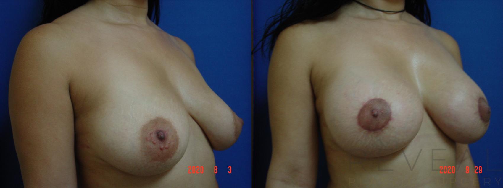 Before & After Breast Augmentation Case 429 View #1 View in San Jose, CA