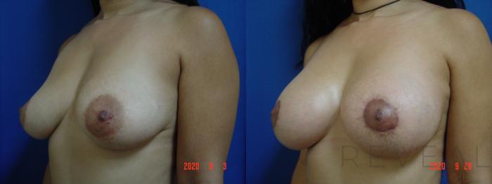 Before & After Breast Augmentation Case 429 View #2 View in San Jose, CA