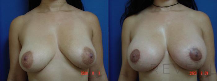 Before & After Breast Augmentation Case 429 View #3 View in San Jose, CA