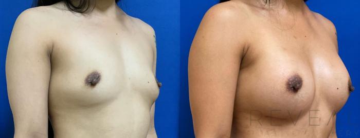 Before & After Breast Augmentation Case 430 View #1 View in San Jose, CA