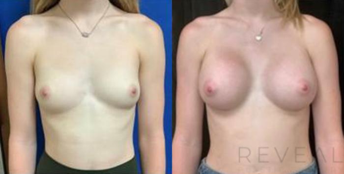 Before & After Breast Augmentation Case 431 View #1 View in San Jose, CA