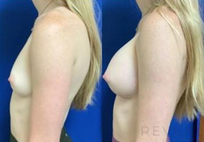 Before & After Breast Augmentation Case 431 View #2 View in San Jose, CA