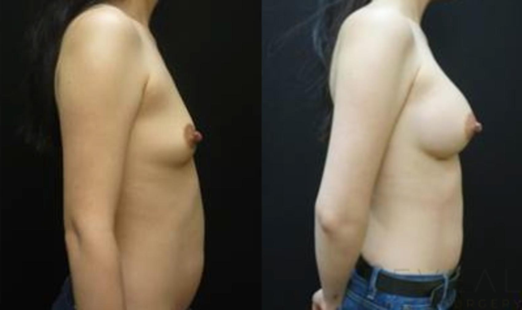 Before & After Breast Augmentation Case 433 View #1 View in San Jose, CA