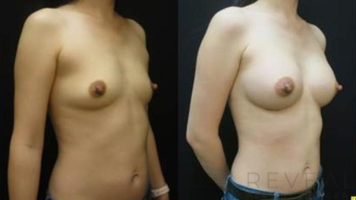 Before & After Breast Augmentation Case 433 View #2 View in San Jose, CA