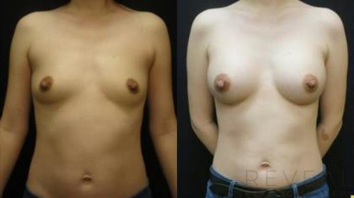 Before & After Breast Augmentation Case 433 View #3 View in San Jose, CA