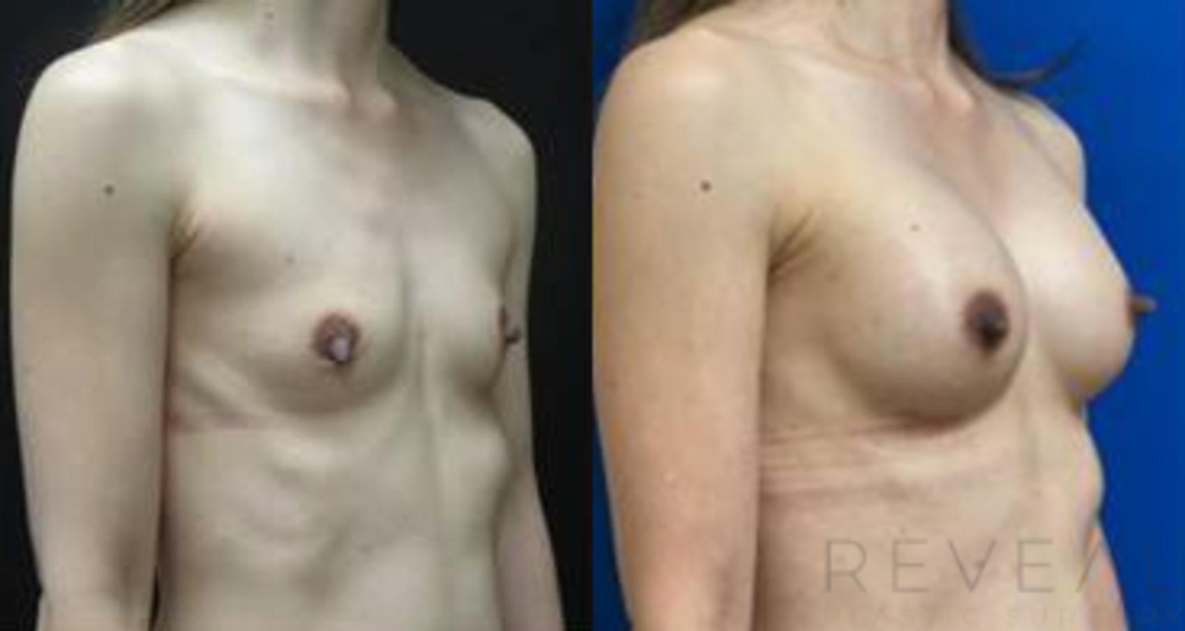 Before & After Breast Augmentation Case 434 View #1 View in San Jose, CA
