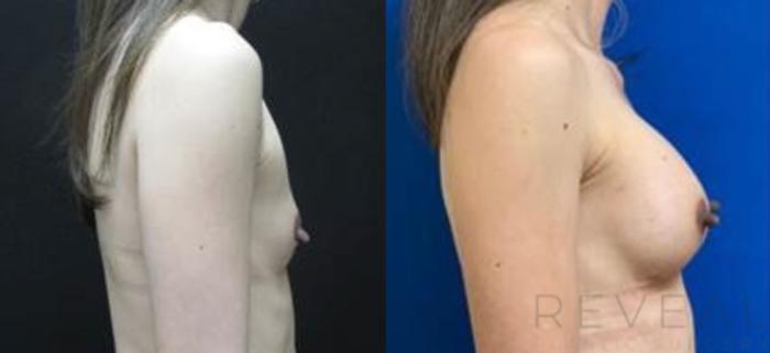 Before & After Breast Augmentation Case 434 View #2 View in San Jose, CA