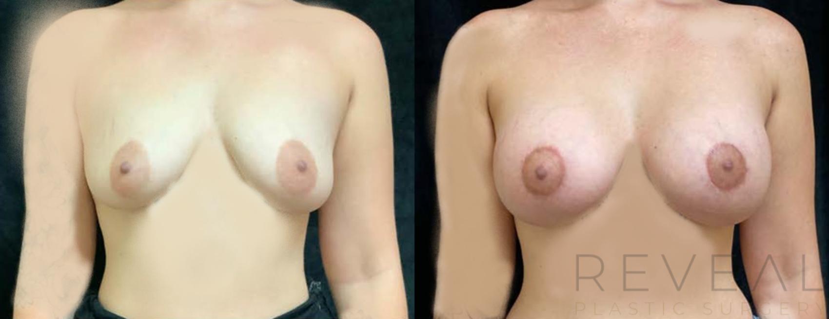 Before & After Breast Augmentation Case 439 View #1 View in San Jose, CA