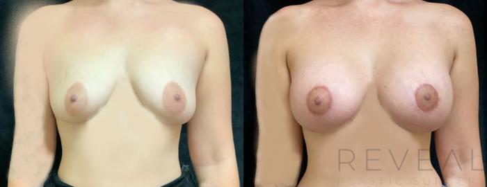 Before & After Breast Lift Case 439 View #1 View in San Jose, CA