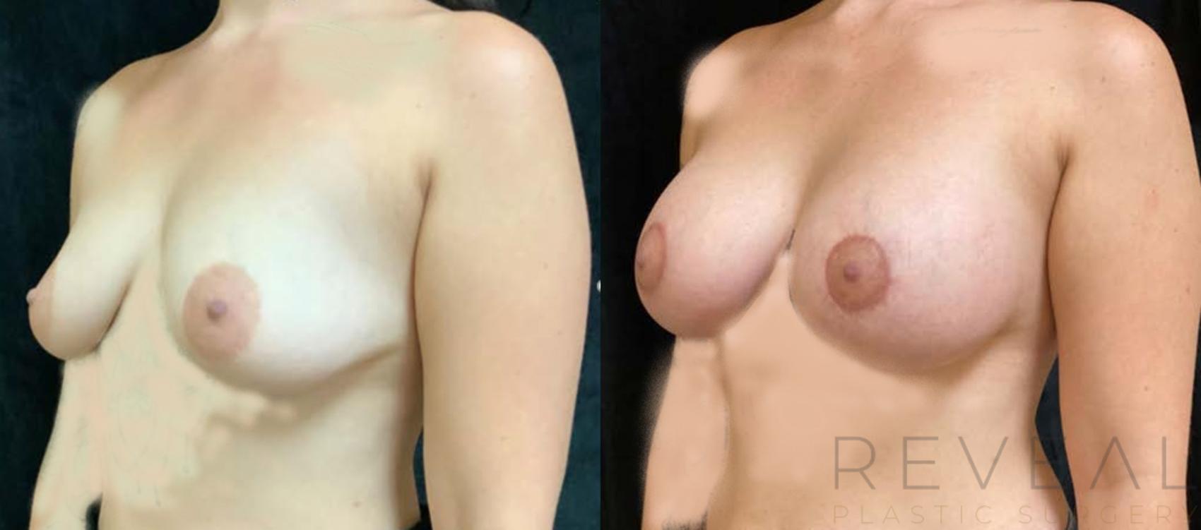 Before & After Breast Augmentation Case 439 View #2 View in San Jose, CA