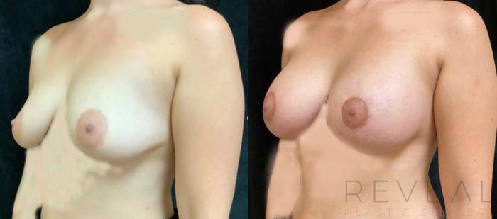 Before & After Breast Lift Case 439 View #2 View in San Jose, CA