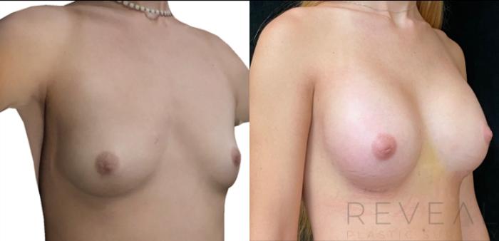 Before & After Breast Augmentation Case 444 View #1 View in San Jose, CA