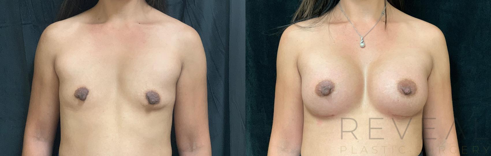 Before & After Breast Augmentation Case 448 View #1 View in San Jose, CA