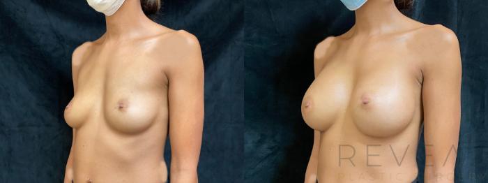 Before & After Breast Augmentation Case 454 View #1 View in San Jose, CA