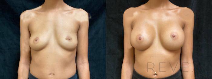 Before & After Breast Augmentation Case 454 View #2 View in San Jose, CA