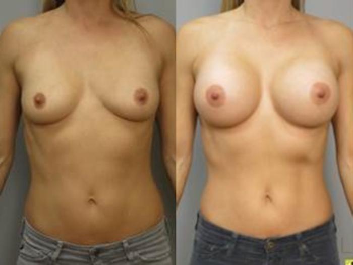 Before & After Breast Augmentation Case 455 View #1 View in San Jose, CA