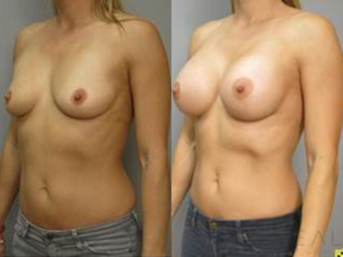 Before & After Breast Augmentation Case 455 View #2 View in San Jose, CA