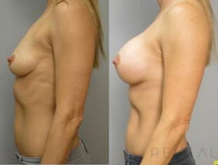 Before & After Breast Augmentation Case 455 View #3 View in San Jose, CA