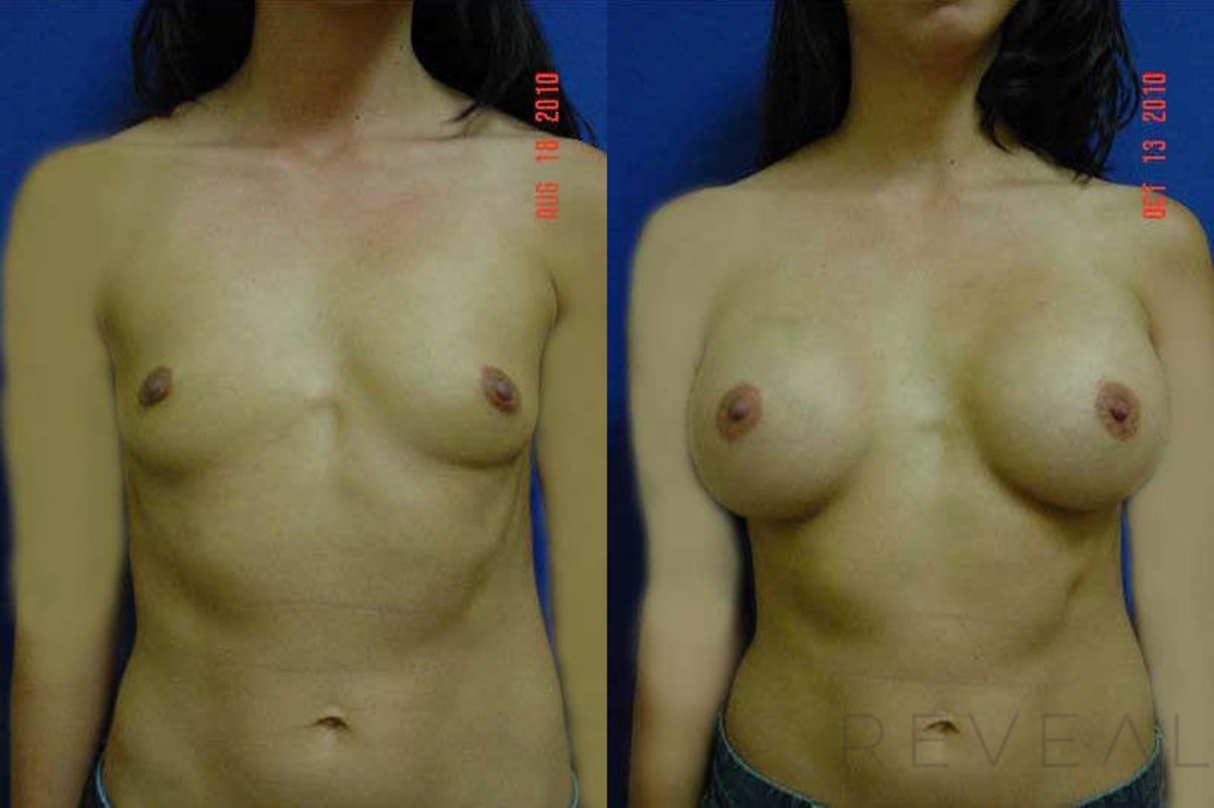 Before & After Breast Augmentation Case 46 View #1 View in San Jose, CA