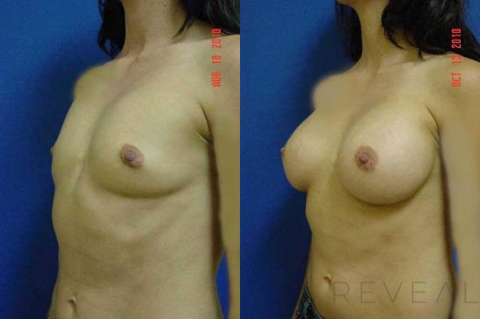 Before & After Breast Augmentation Case 46 View #2 View in San Jose, CA