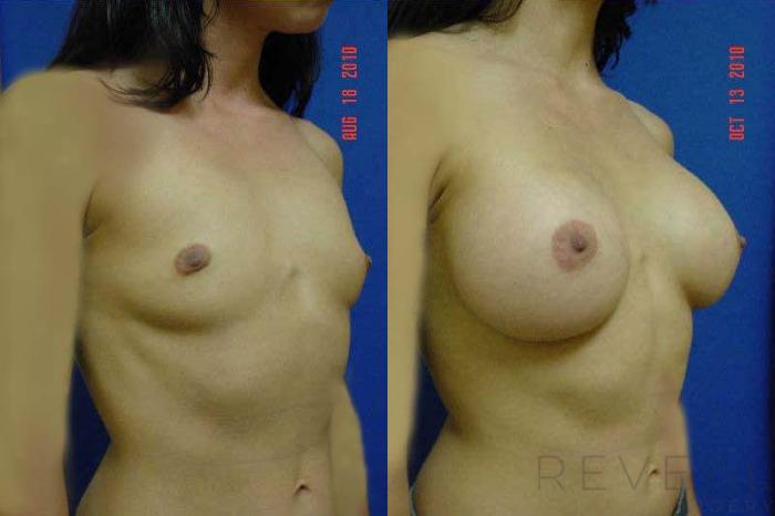 Before & After Breast Augmentation Case 46 View #3 View in San Jose, CA