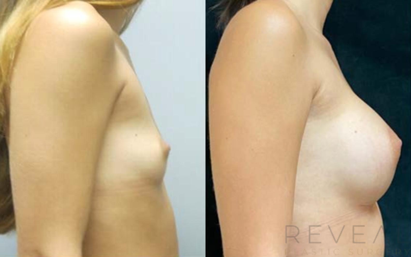 Before & After Breast Augmentation Case 470 View #1 View in San Jose, CA