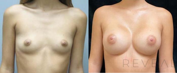 Before & After Breast Augmentation Case 470 View #2 View in San Jose, CA