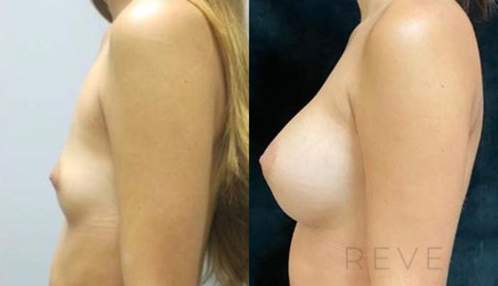 Before & After Breast Augmentation Case 470 View #3 View in San Jose, CA