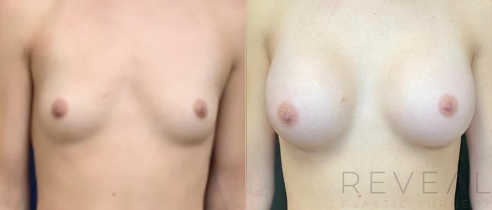 Before & After Breast Augmentation Case 473 View #1 View in San Jose, CA