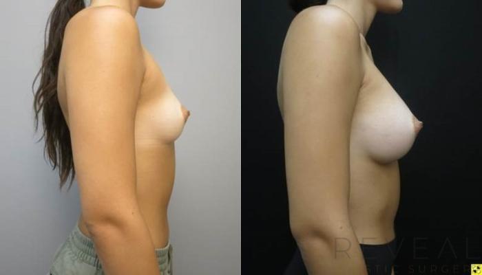 Before & After Breast Augmentation Case 485 View #1 View in San Jose, CA