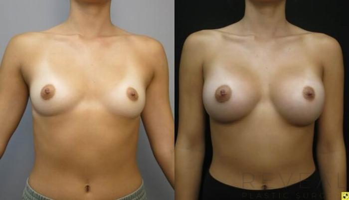 Before & After Breast Augmentation Case 485 View #2 View in San Jose, CA