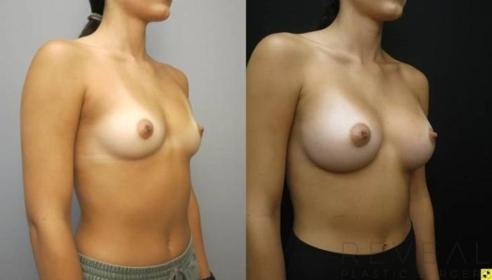 Before & After Breast Augmentation Case 485 View #3 View in San Jose, CA