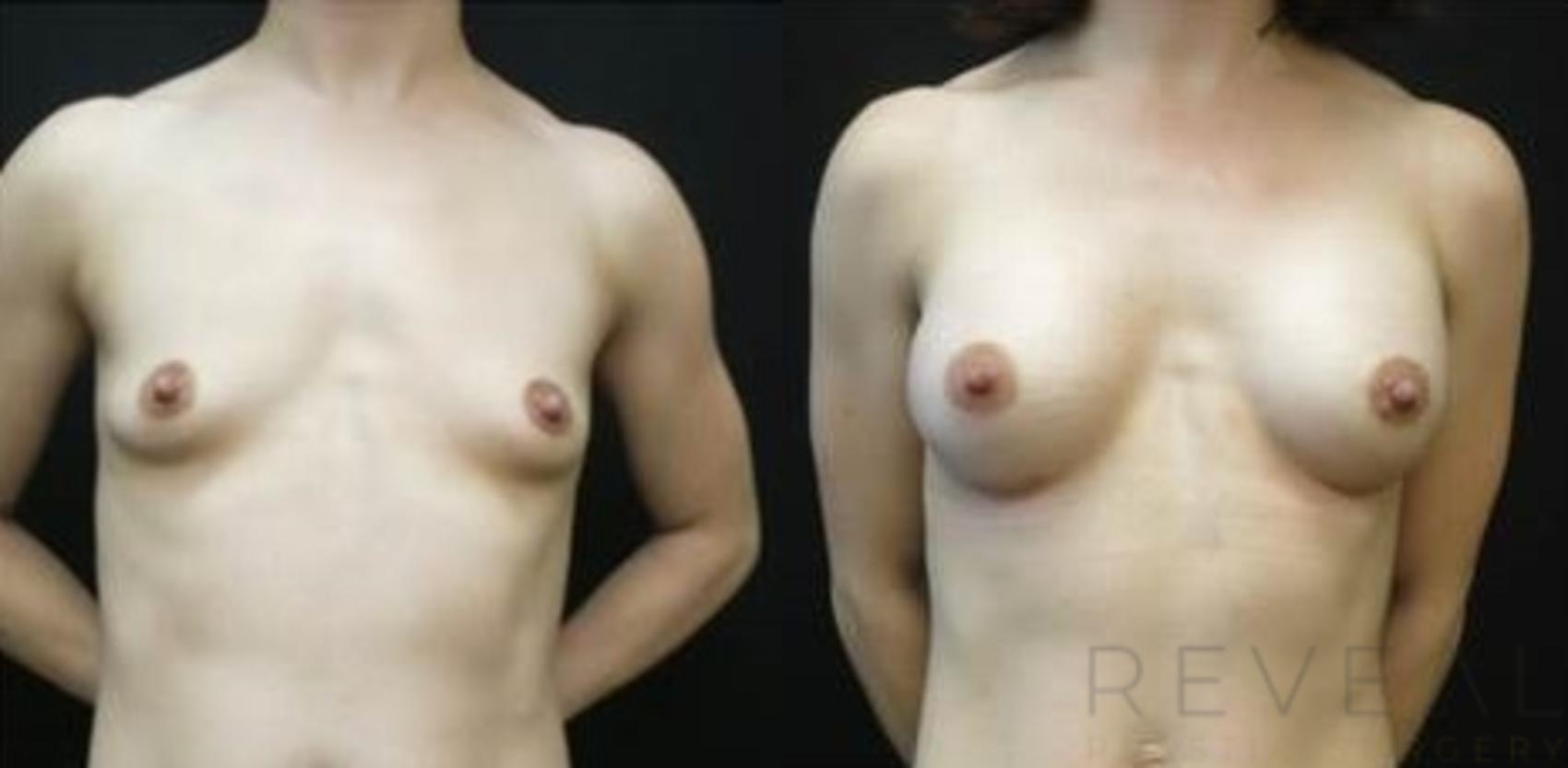 Before & After Breast Augmentation Case 486 View #1 View in San Jose, CA