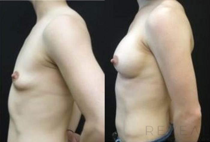 Before & After Breast Augmentation Case 486 View #2 View in San Jose, CA