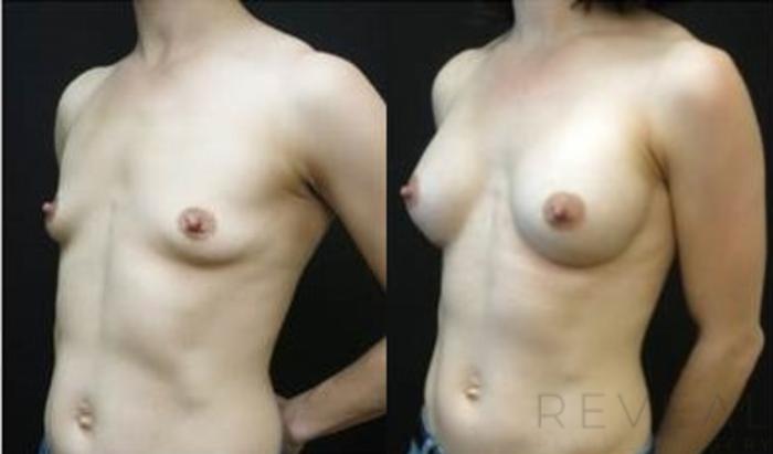 Before & After Breast Augmentation Case 486 View #3 View in San Jose, CA