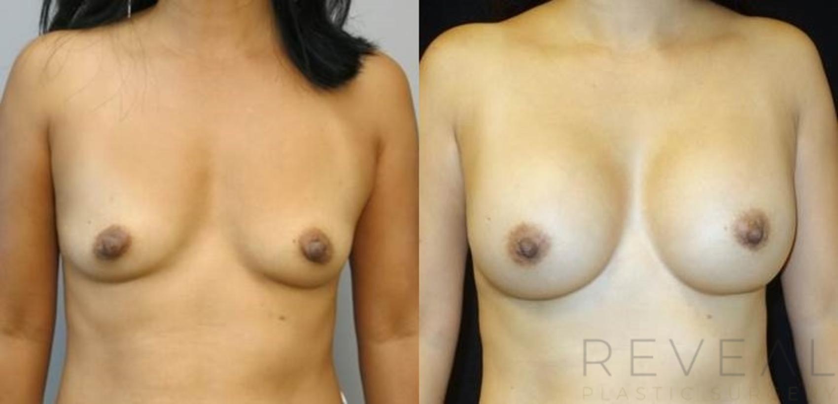 Before & After Breast Augmentation Case 489 View #1 View in San Jose, CA