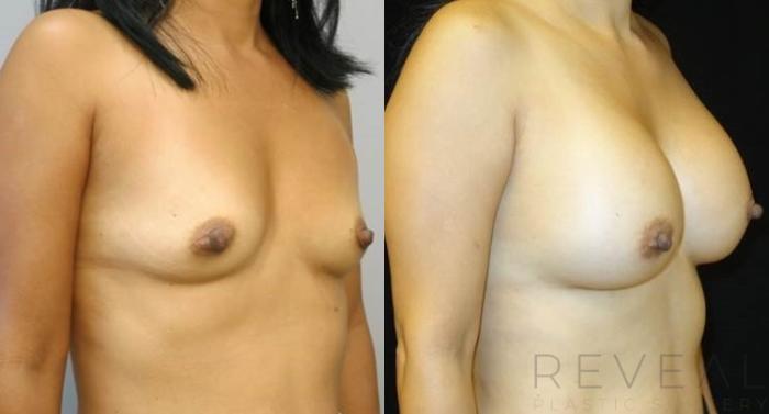 Before & After Breast Augmentation Case 489 View #2 View in San Jose, CA