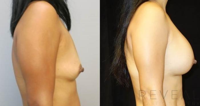 Before & After Breast Augmentation Case 489 View #3 View in San Jose, CA